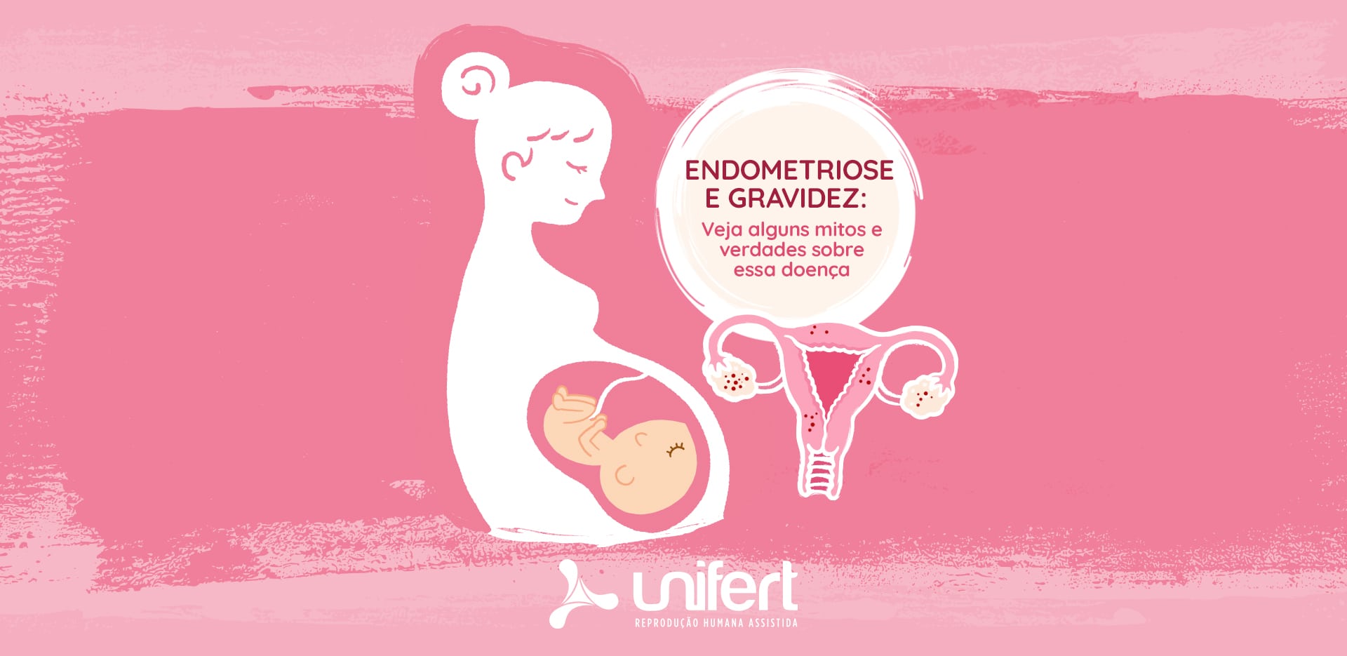 Endometriose e gravidez: veja alguns mitos e verdades sobre essa doença